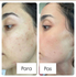 Fotoja e Serum kundër akneve The Ordinary Salicylic Acid 2%, 30ml, Picture 2