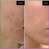 Fotoja e Serum kundër akneve The Ordinary Salicylic Acid 2%, 30ml, Picture 3