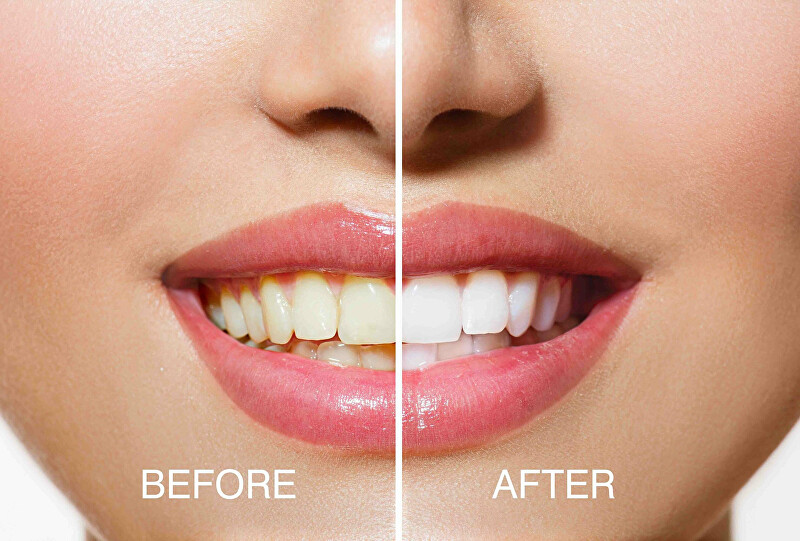 Llambë për zbardhje të dhëmbëve Rio-Beauty USB Teeth Whitening kRIO101